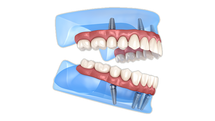 all-on-4 dental implants